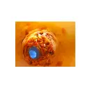 interior_2_de_esofago_con_cancer___copia.webp